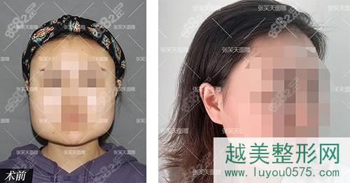 北京圣嘉新医疗美容张笑天院长下颌角手术真人案例
