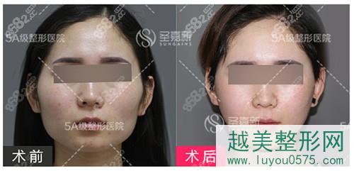 北京圣嘉新医疗美容颧骨颧弓下颌角轮廓手术案例