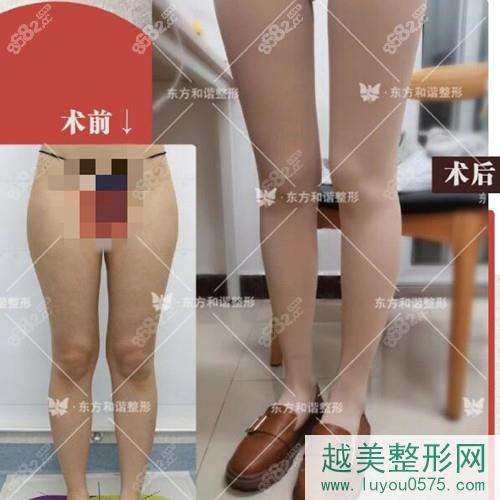 北京东方和谐冯斌大腿吸脂案例