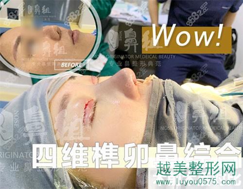 南京鼻祖整形四维榫卯鼻部手术案例