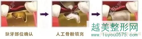 种植牙的骨粉