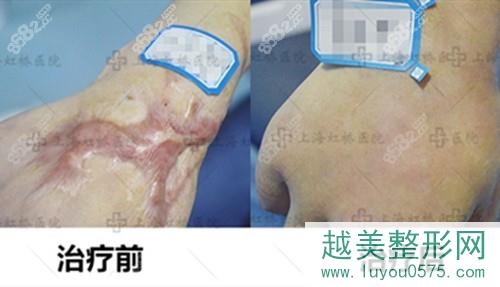 上海虹桥医院疤痕科修复案例对比