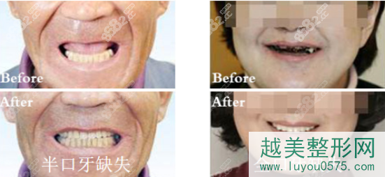 重庆牙卫士口腔医院牙齿种植案例