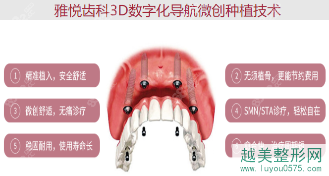 上海雅悦齿科做种植牙的技术怎么样