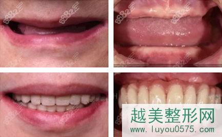 上海雅悦齿科全口种植牙案例图