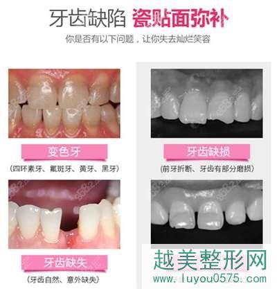 瓷贴面可以改善哪些牙齿问题