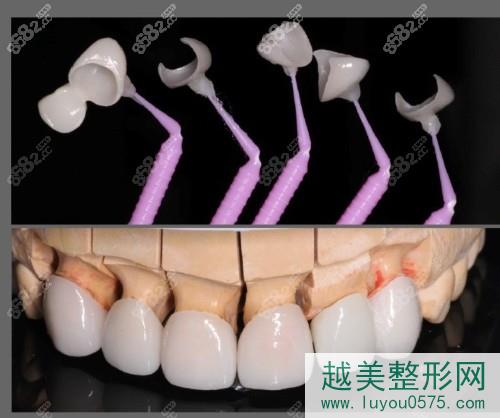 牙缝大这样修复好!看杭州国 际牙科全瓷贴面操作过程及果!