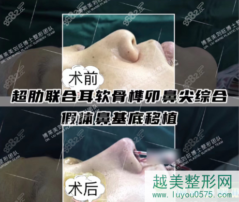 刘旺医生超肋+耳软骨鼻部手术果图