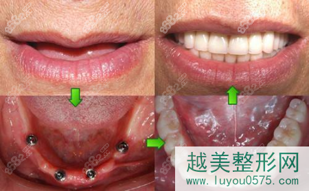 上海拜博口腔全口牙种植案例