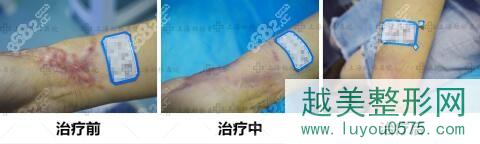 上海虹桥医院多维综合祛疤真人前后对比案例