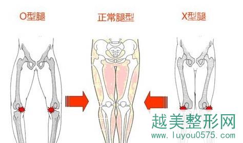 o型腿手术和正常腿型不止是脂肪问题