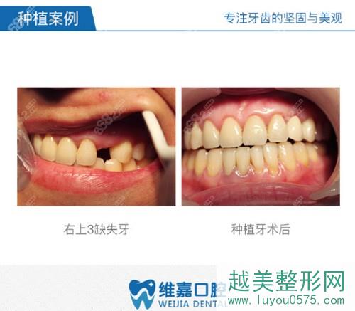 北京维嘉口腔种植牙案例