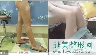 北京雅靓医疗美容医院大腿吸脂案例图
