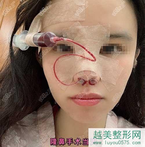 广州曙光鼻部手术分享