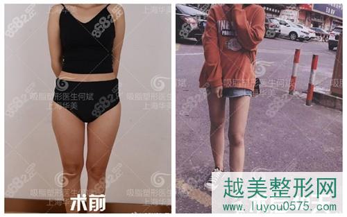 上海华美大腿吸脂案例