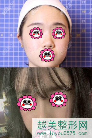 重庆艺星医疗美容整形鼻部案例