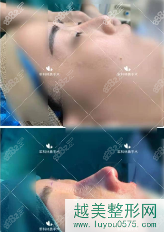 重庆军科林勇半肋鼻部手术修复案例
