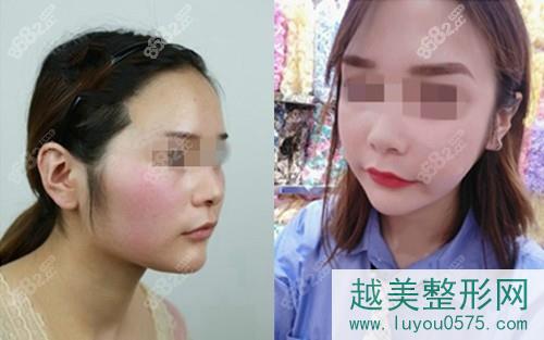 上海首尔丽格石润下颌角手术案例