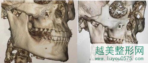 上海美联臣下颌角手术前后对比果