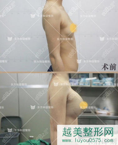 东方和谐冯斌医生自体脂肪隆胸案例图