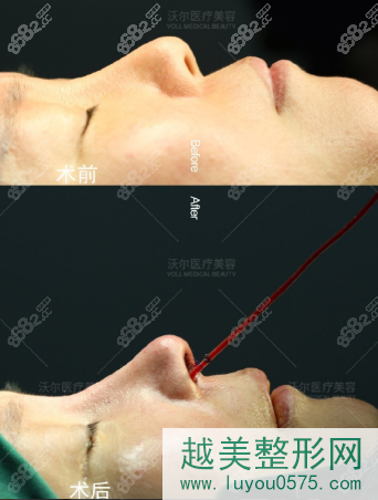 刘彦军肋骨鼻部手术修复果图