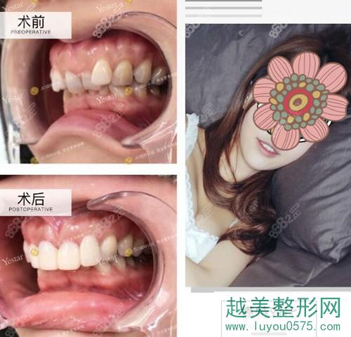 宁波鄞州艺星时代整形口腔医院牙齿矫正真人案例