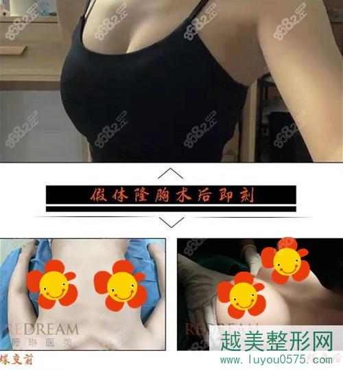 杭州薇琳假体隆胸案例果图