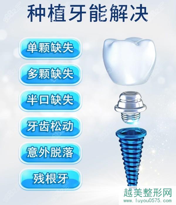 上海鼎植口腔种植牙技术
