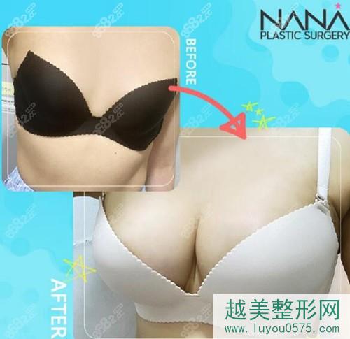 韩国NANA整形医院假体隆胸真人案例