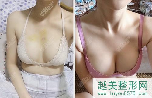 韩国普罗菲耳隆胸修复真人案例