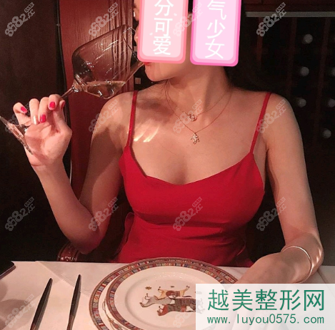 上海华美谢卫国傲诺拉圆形假体隆胸案例