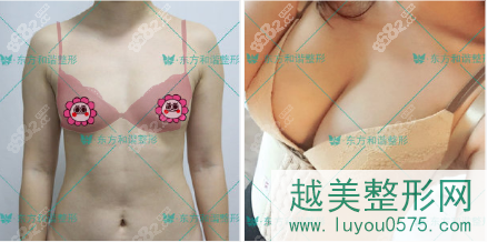 北京东方和谐自体脂肪隆胸案例图片参考