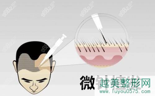 杭州薇琳植发中心做微针植发手术