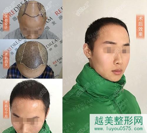 杭州薇琳植发头顶加密种植案例