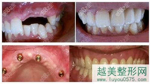 上海雅悦口腔种植牙案例