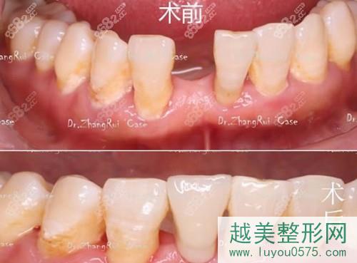 上海亿大口腔单颗牙缺失种植案例