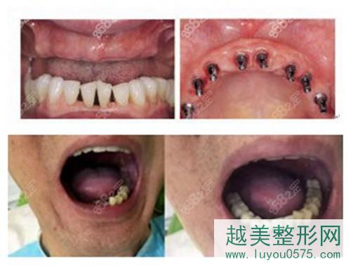 上海鼎植永博口腔种植牙案例前后对比