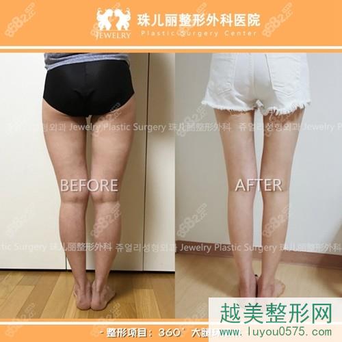 韩国珠儿丽大腿吸脂案例