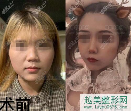 上海薇琳下颌角手术案例