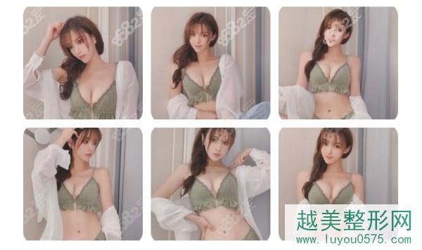 上海美莱医疗美容医院傲诺拉闪耀假体隆胸案例