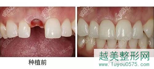 北京钛植口腔种植牙案例前后对比