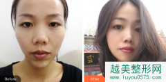 上海解放军第四五五医院激光整形科整形价格表及隆鼻隆胸案例