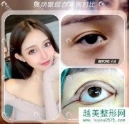 上海千美整形医院割双眼皮靠谱吗?附灵动眼部手术案例对比照