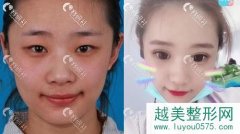 天津割双眼皮医院排名公布，美莱、伊美尔、维美案例对比