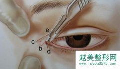 开眼角手术有什么方法 什么样的人群适合开眼角手术