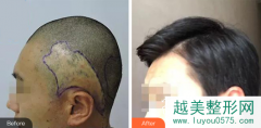 杭州新生植发医院价格表及发际线植发案例