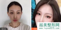 北京悦丽汇医疗美容诊所价格表及隆鼻隆胸案例