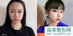 北京薇琳医疗美容医院价格表及隆鼻隆胸案例