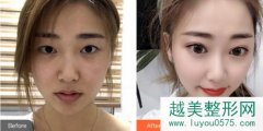 北京叶美人医疗美容诊所价格表及隆鼻隆胸案例