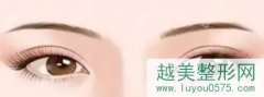上海美莱哪个医生做眼睛好？何祥龙双眼皮案例价格表参考